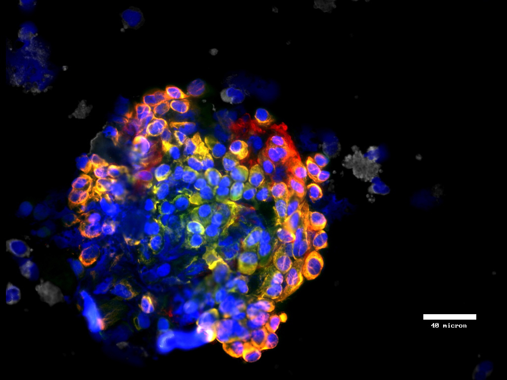 Cluster of CK+ (green) and mesenchymal (red) CTCs from breast cancer patient (20x)