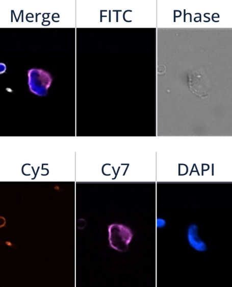Epithelial and Mesenchymal CTC Detection in Triple Negative Breast Cancer Patients using ANGLE’s Parsortix® System