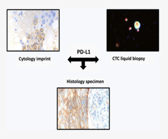 Parsortix technology lung cancer
